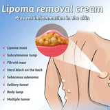 Lipoma Removal Cream | Herbal Skin Care Cream for Smooth & Nourished Skin | Fast-Absorbing Formula | For Neck & Body | 50g